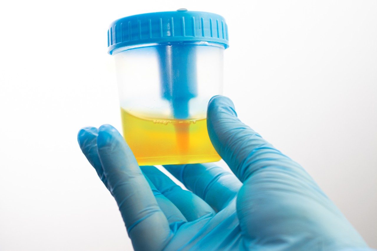 Urine analysis sample in container